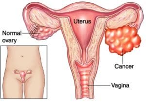 Ovarian Cancer