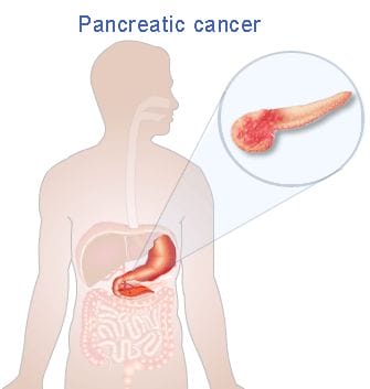 dr-oz-pancreatic-cancer-risks